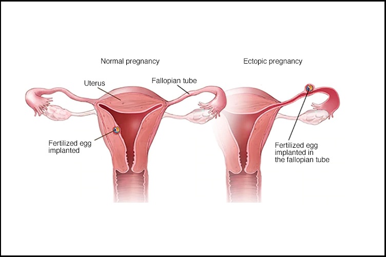 Hysterectomy Clinic in Pune